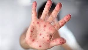 Virus Mpox Belum Terdeteksi di Riau, Warga  Diimbau Tetap Waspada