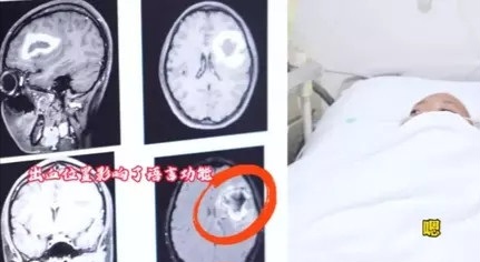 Wanita di China Mendadak Kehilangan Kemampuan Bahasa Inggris, Kenapa?
