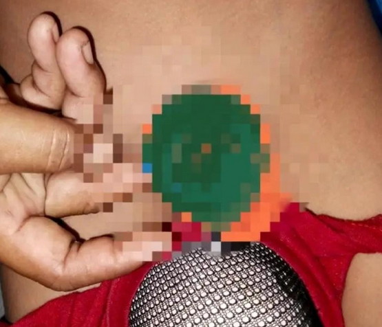 Kepala Kelamin Bocah SD di Pelalawan Terputus Usai Sunat di Bidan Mandiri