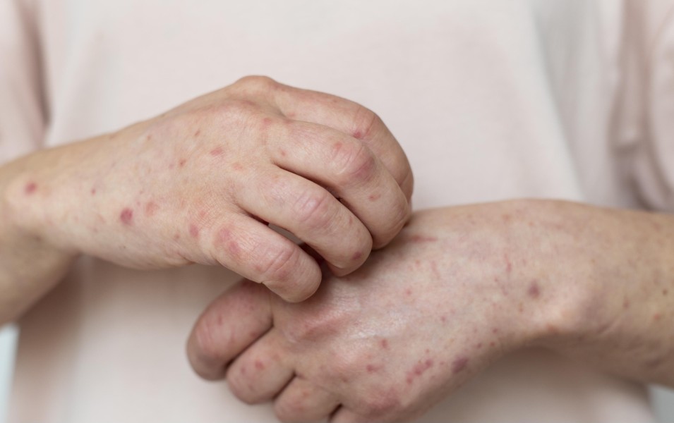 Kemenkes Waspadai Kasus Campak Nasional dan Global